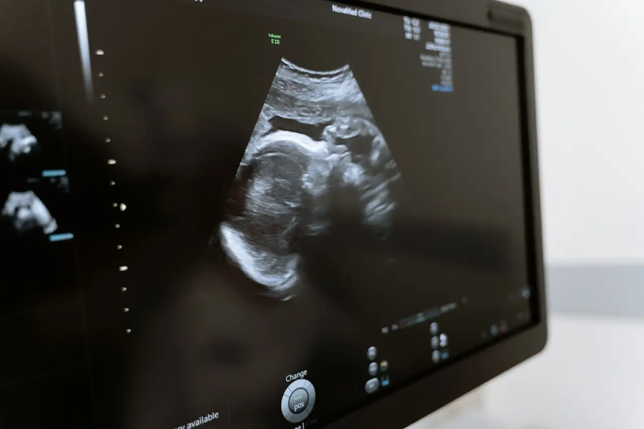 Ultrasound Image on Medical Monitor
